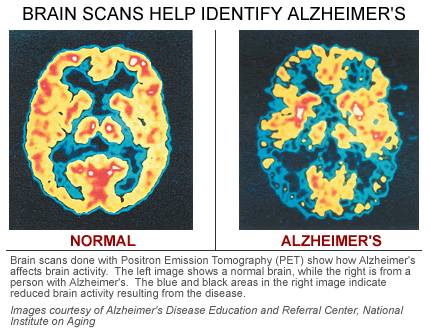 Brain Scan Results